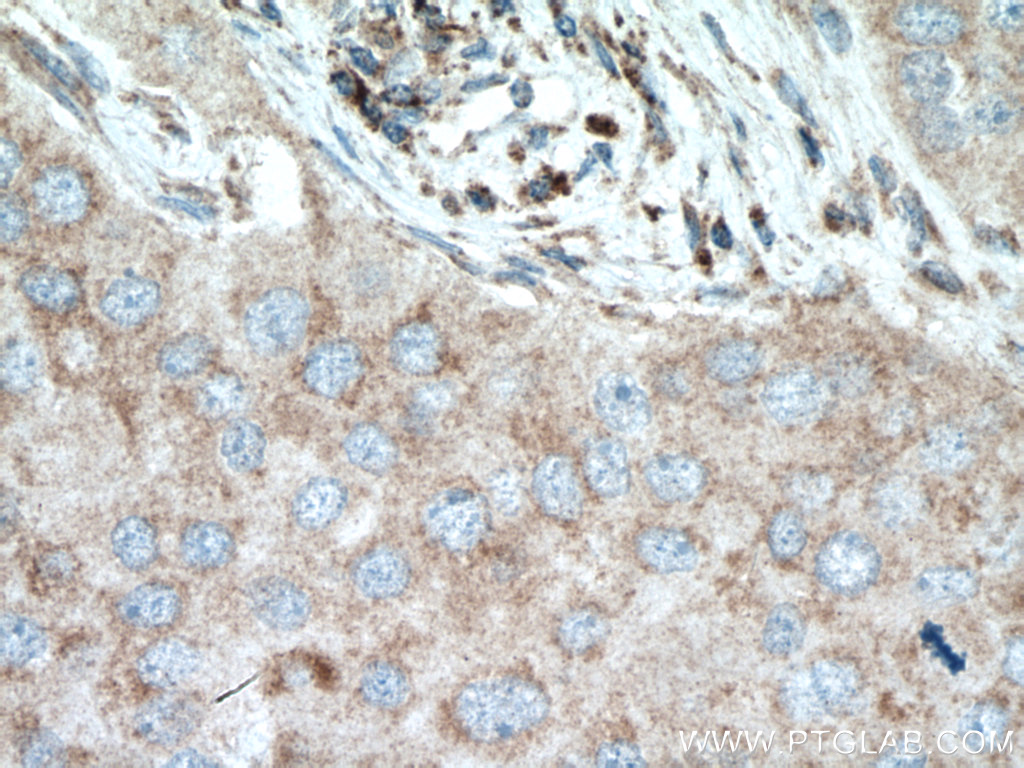 IHC staining of human breast cancer using 26804-1-AP