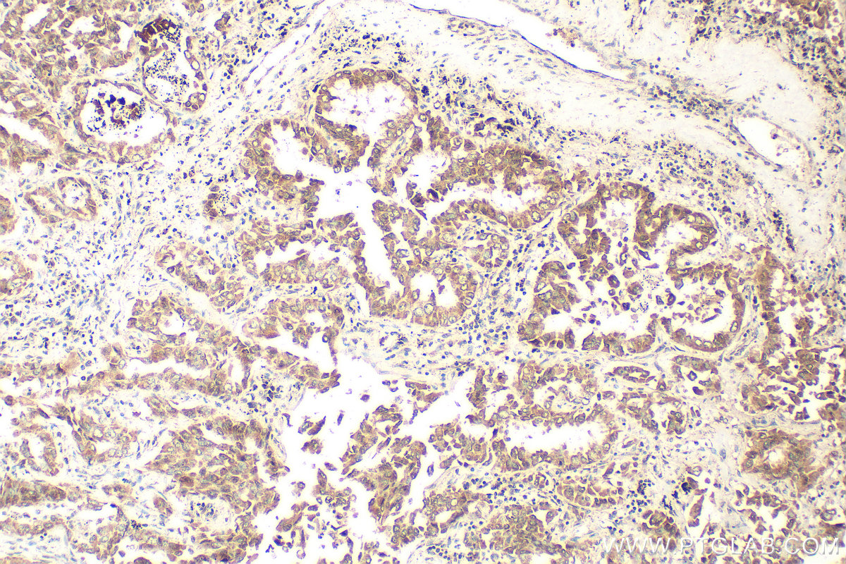 Immunohistochemical analysis of paraffin-embedded human lung cancer tissue slide using 10789-1-AP (SLC25A13 antibody) at dilution of 1:400 (under 10x lens). Heat mediated antigen retrieval with Tris-EDTA buffer (pH 9.0). IHC staining of human lung cancer using 10789-1-AP
