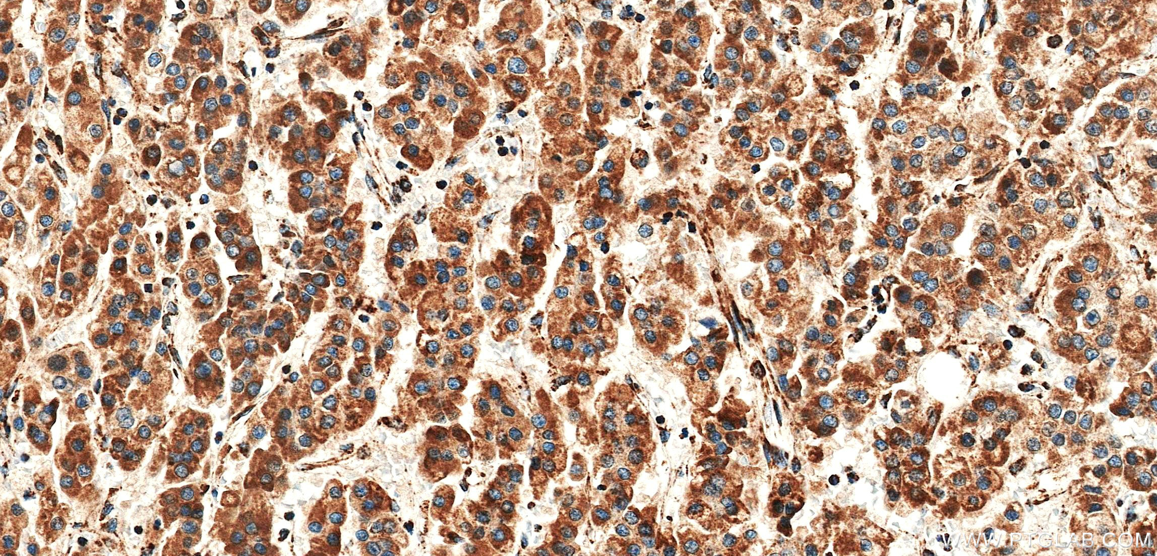 IHC staining of Human Hepatocellular cancer using 86635-1-RR IHC staining of Human Hepatocellular cancer using 86635-1-RR