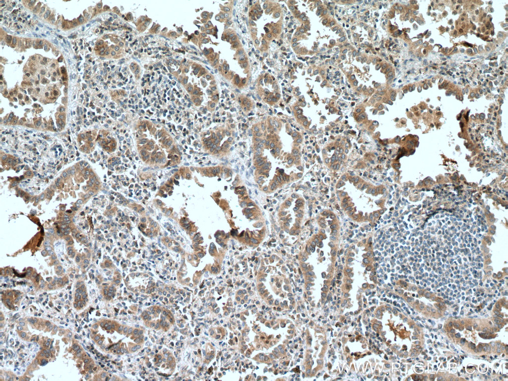 IHC staining of human lung cancer using 10420-1-AP