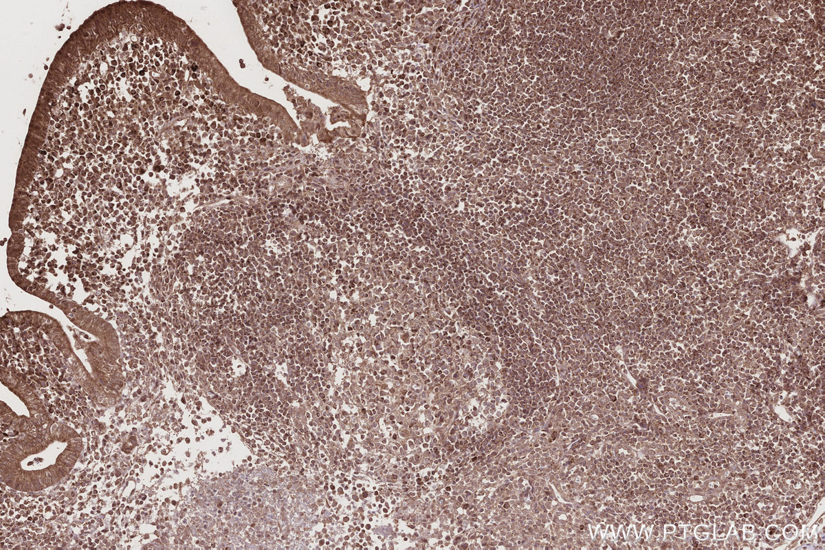 IHC staining of human appendicitis using 12277-1-AP IHC staining of human appendicitis using 12277-1-AP