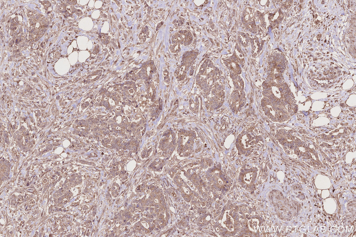 IHC staining of human rectal cancer using 12277-1-AP IHC staining of human rectal cancer using 12277-1-AP