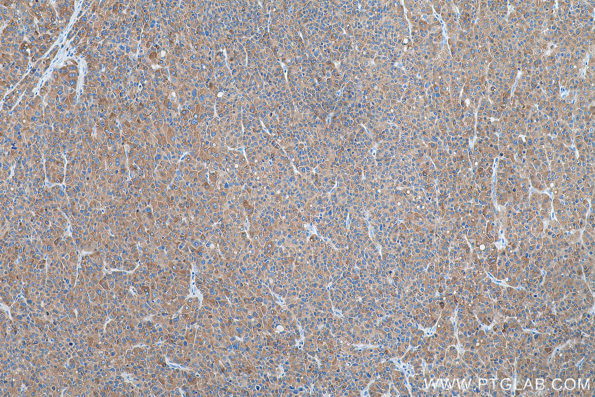 IHC staining of human liver cancer using 14048-1-AP