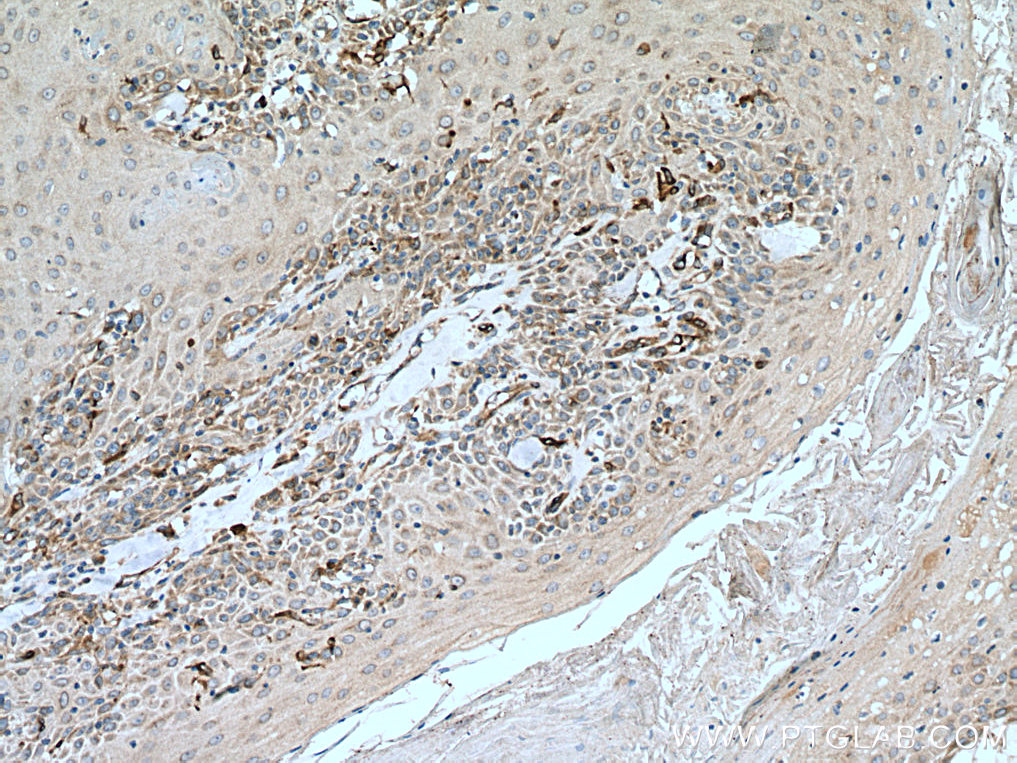 IHC staining of human skin cancer using 12943-1-AP