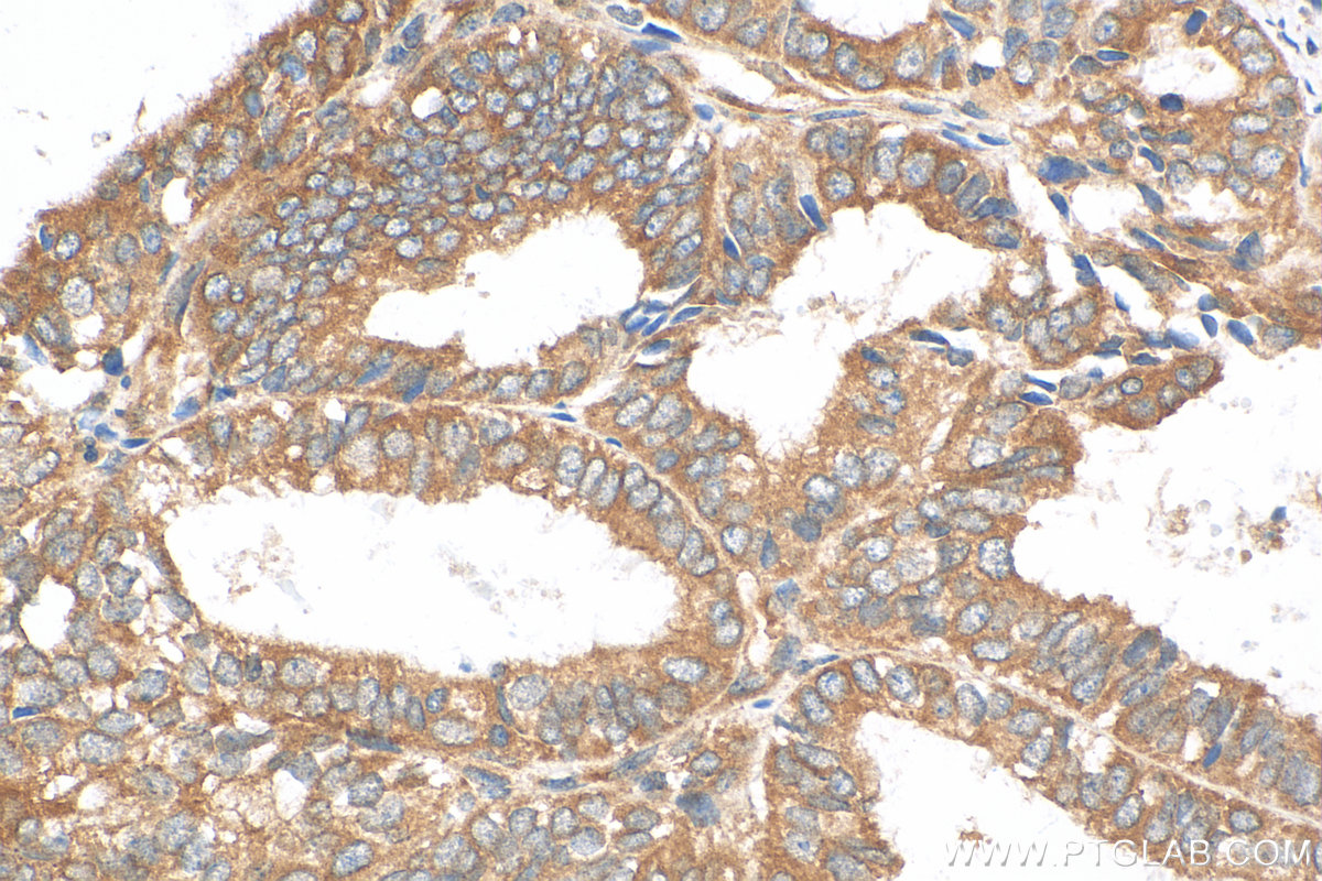 IHC staining of human ovary tumor using 11013-1-AP