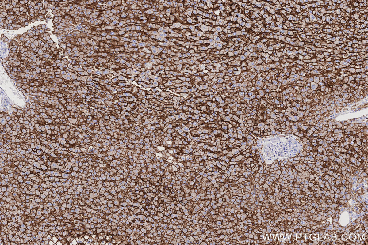 IHC staining of human hepatocirrhosis using 20436-1-AP