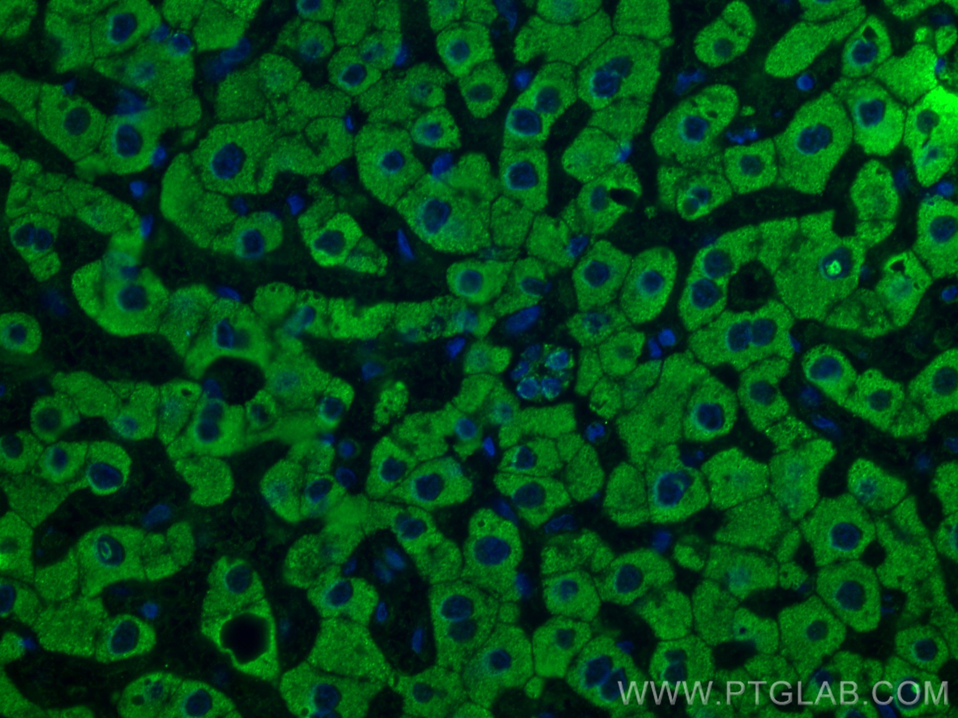 IF Staining of human hepatocirrhosis using 67530-1-Ig