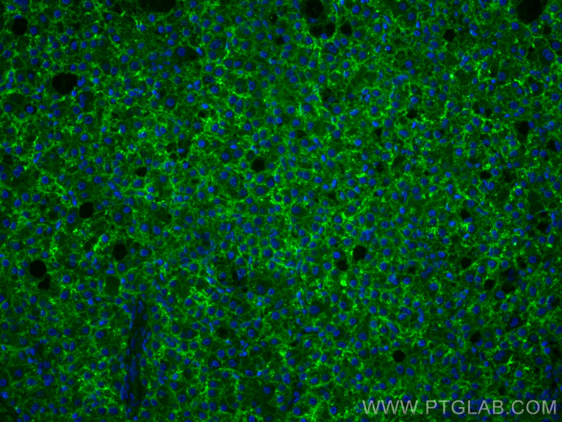 IF Staining of human liver cancer using 27499-1-AP