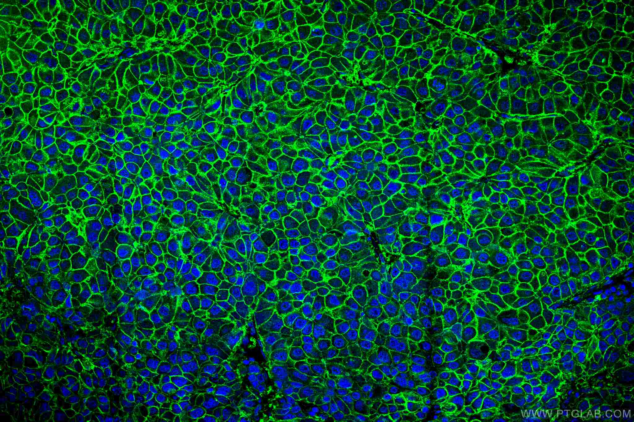 IF Staining of human liver cancer using 67221-1-Ig