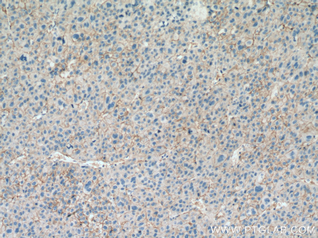 IHC staining of human liver cancer using 67221-1-Ig