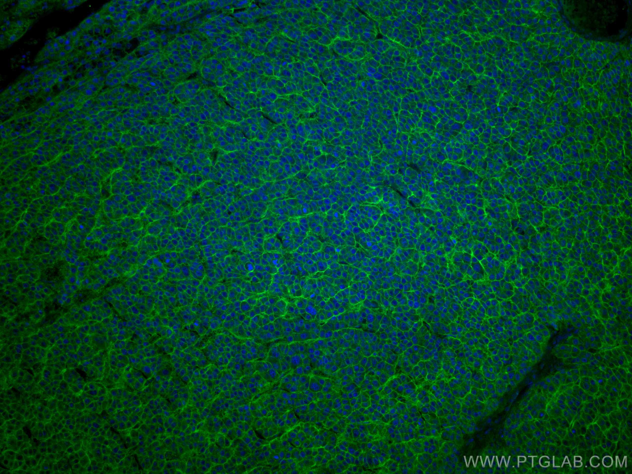 IF Staining of human liver cancer using CL488-67221