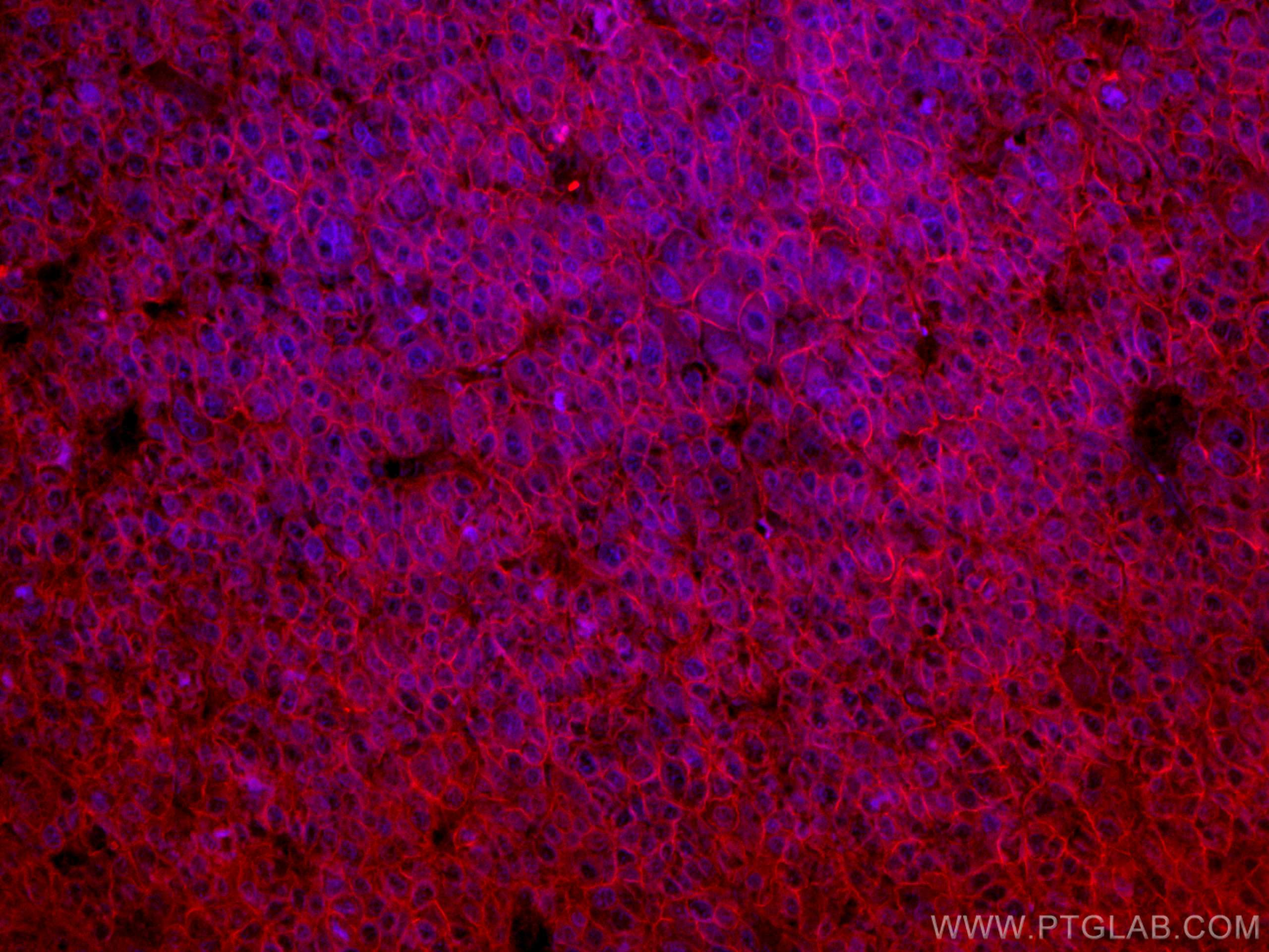 IF Staining of human liver cancer using CL594-67221