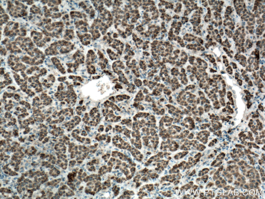 IHC staining of human liver cancer using 13657-1-AP