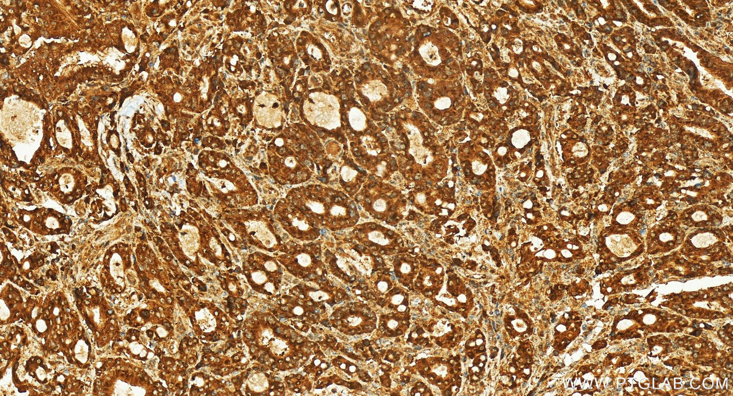 IHC staining of human stomach cancer using 24582-1-AP