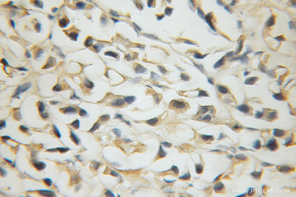 IHC staining of human prostate cancer using 12039-1-AP