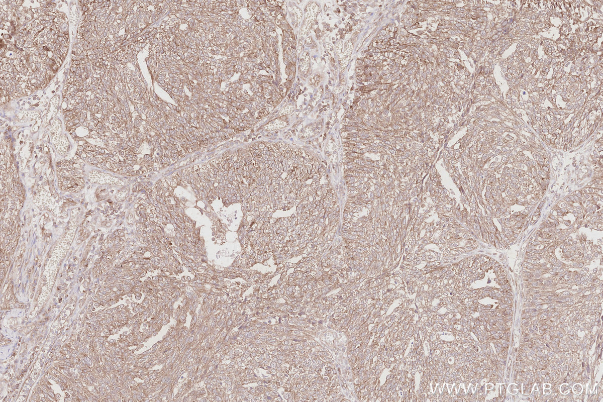 IHC staining of human ovary cancer using 28632-1-AP IHC staining of human ovary cancer using 28632-1-AP