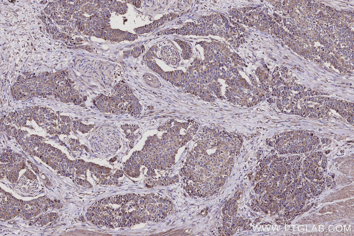 IHC staining of human stomach cancer using 20458-1-AP IHC staining of human stomach cancer using 20458-1-AP