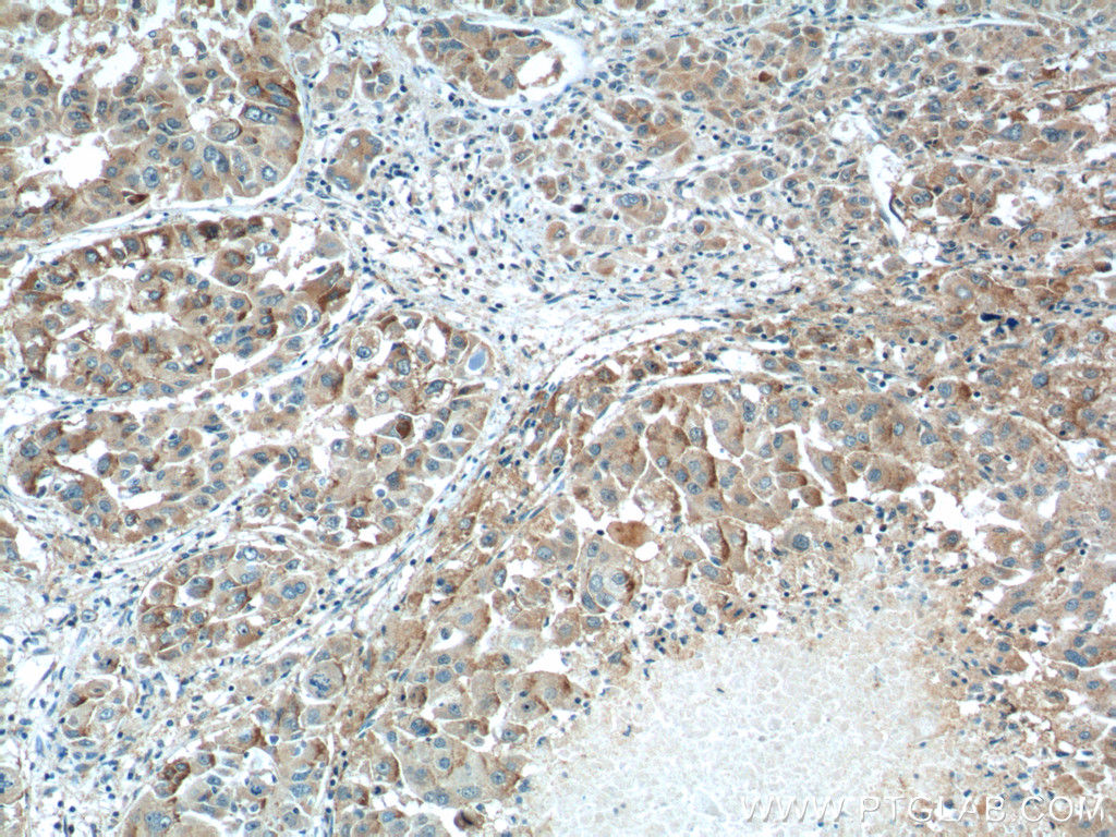 IHC staining of human liver cancer using 20625-1-AP