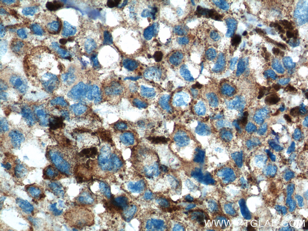 IHC staining of human malignant melanoma using 10453-1-AP