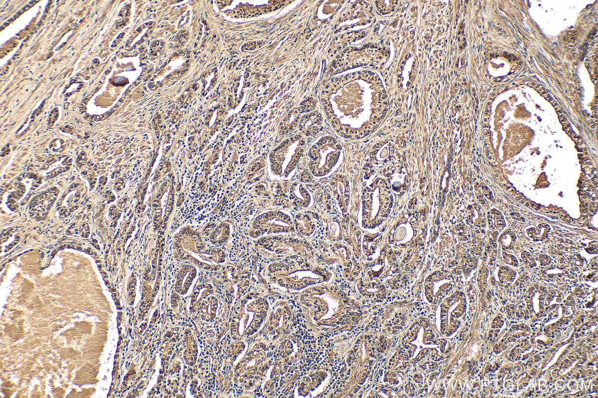IHC staining of human prostate hyperplasia using 14224-1-AP (same clone as 14224-1-PBS)
