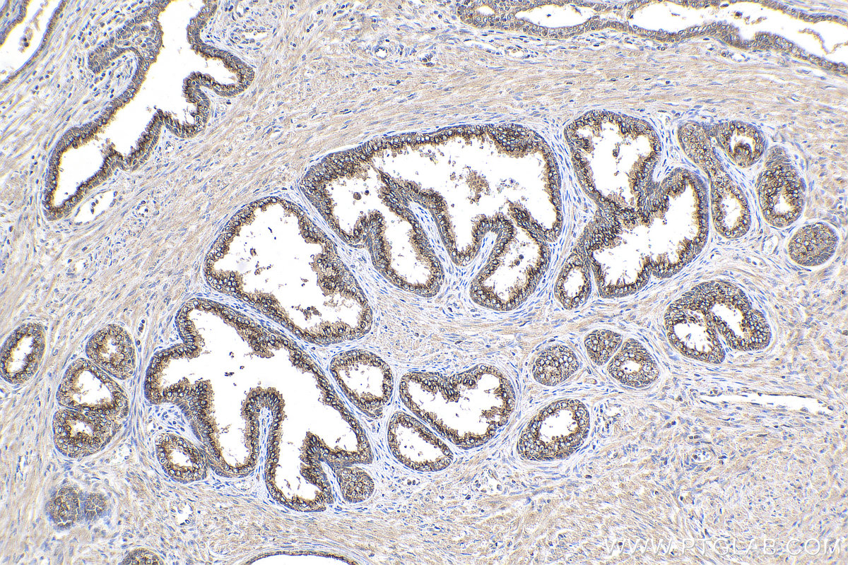 IHC staining of human prostate cancer using 14224-1-AP (same clone as 14224-1-PBS)