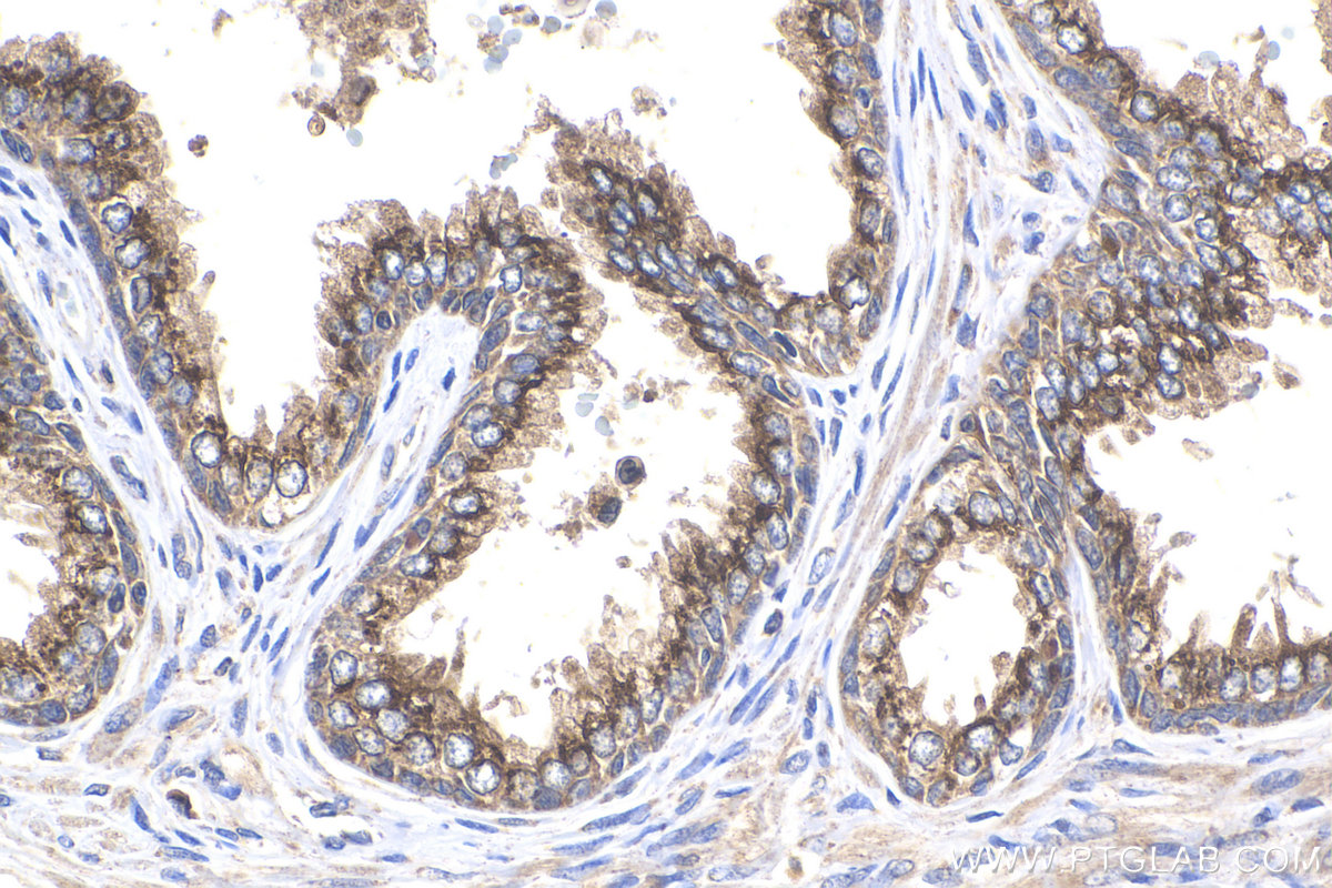 IHC staining of human prostate cancer using 14224-1-AP (same clone as 14224-1-PBS)
