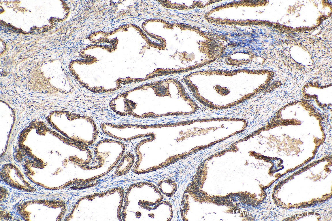 IHC staining of human prostate cancer using 60343-1-Ig