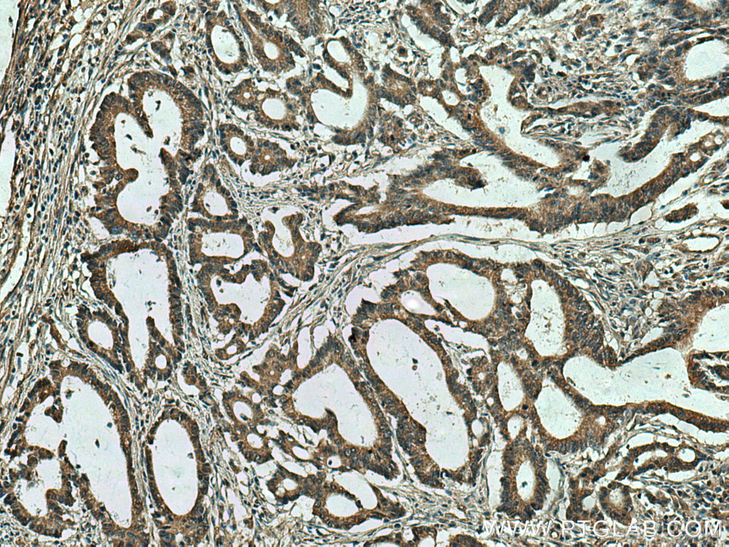 IHC staining of human colon cancer using 14089-1-AP