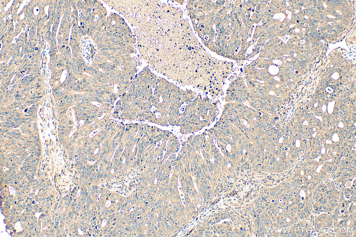IHC staining of human ovary tumor using 14195-1-AP