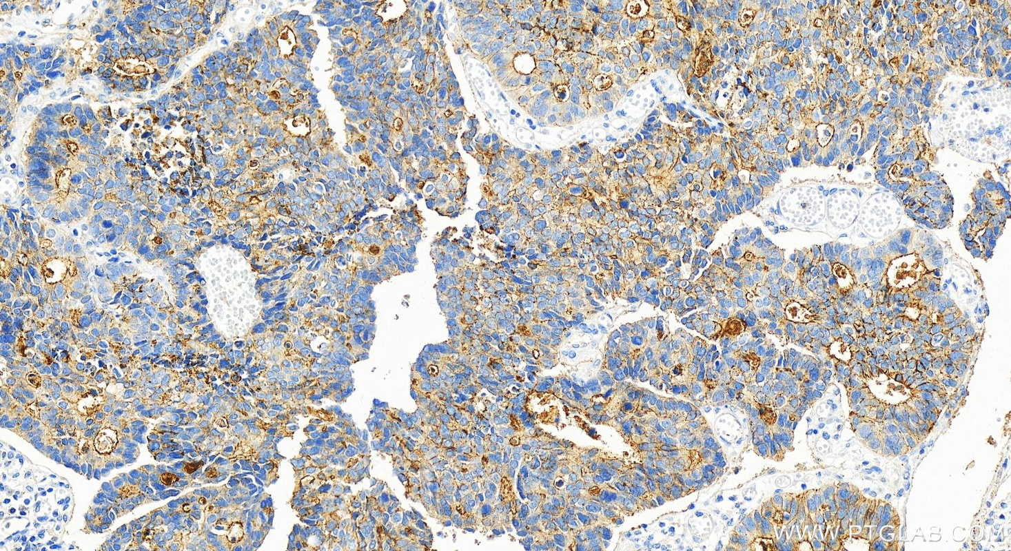 IHC staining of human stomach cancer using 30232-1-AP
