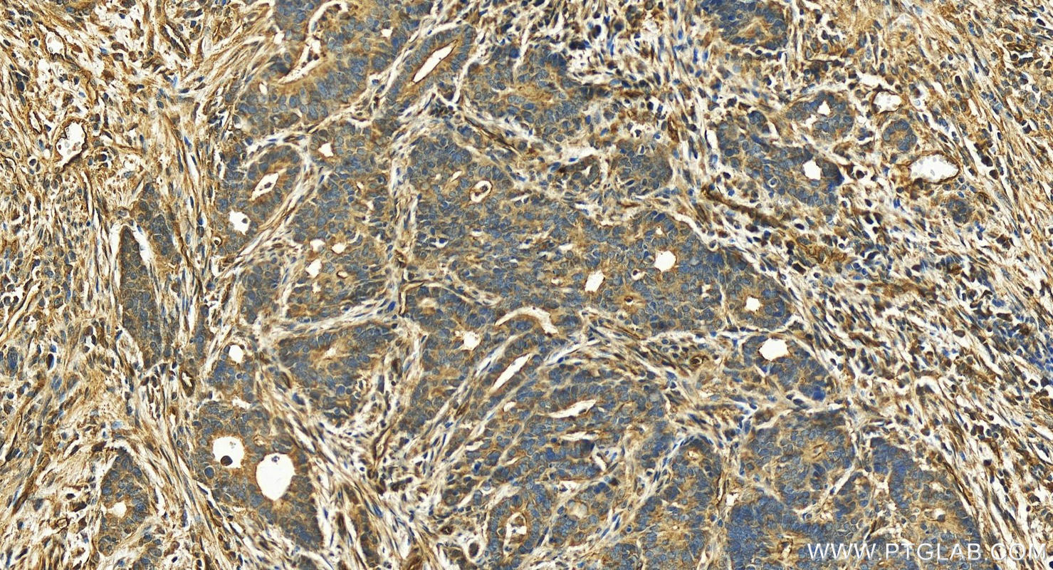 IHC staining of human stomach cancer using 18891-1-AP