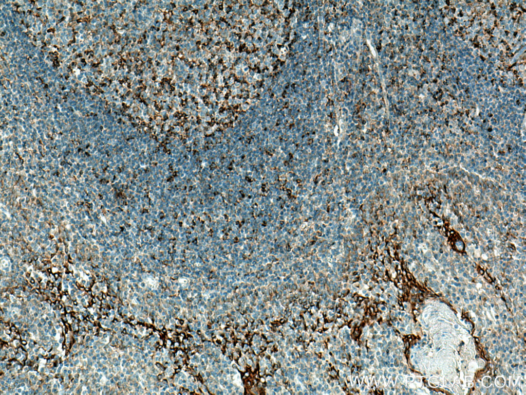 IHC staining of human tonsillitis using 13718-1-AP