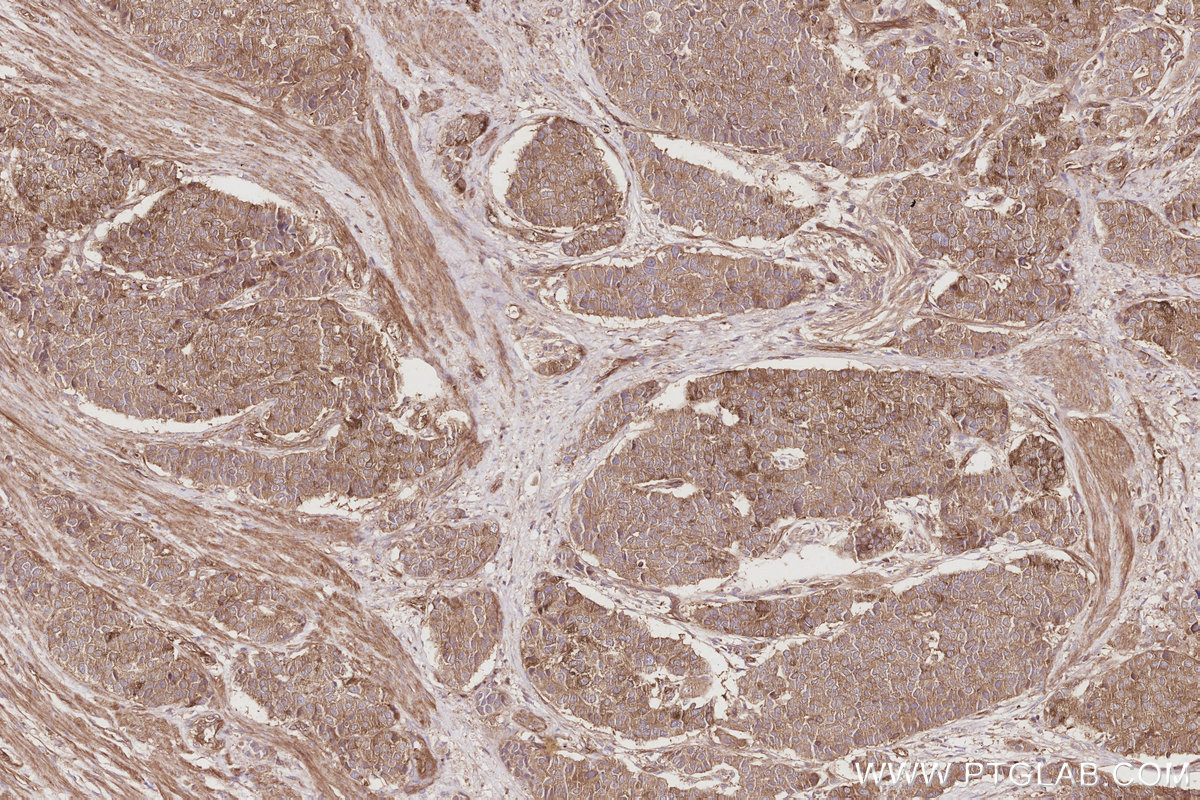 IHC staining of human stomach cancer using 19743-1-AP IHC staining of human stomach cancer using 19743-1-AP