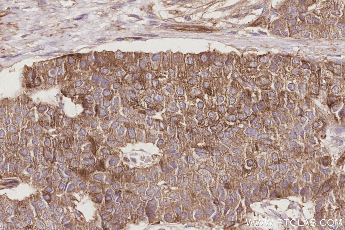 IHC staining of human stomach cancer using 19743-1-AP IHC staining of human stomach cancer using 19743-1-AP