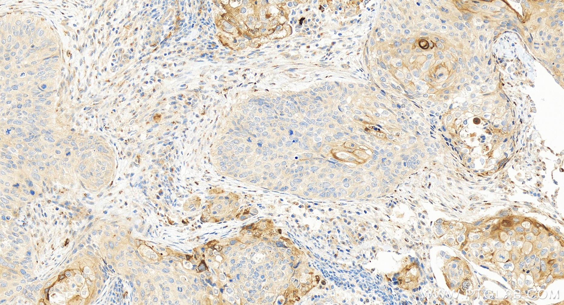 IHC staining of human cervical cancer using 83965-4-RR (same clone as 83965-4-PBS)