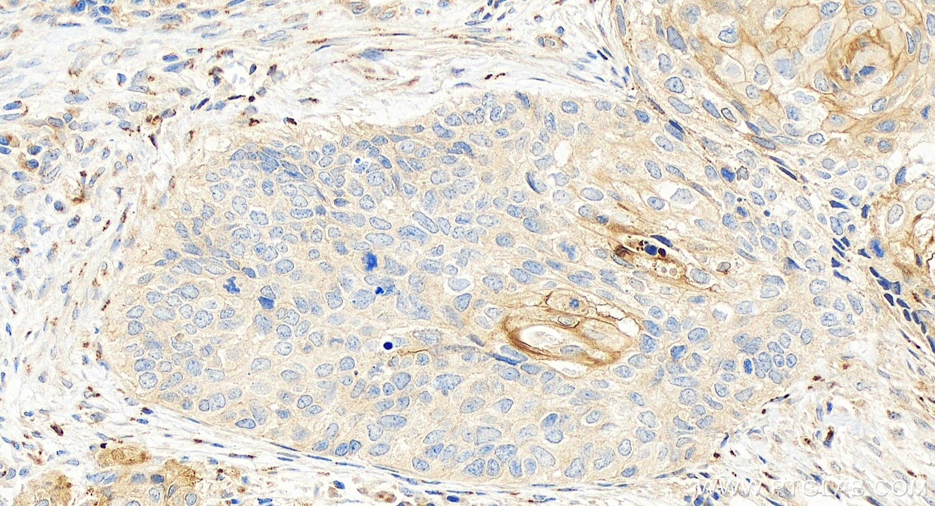 IHC staining of human cervical cancer using 83965-4-RR (same clone as 83965-4-PBS)