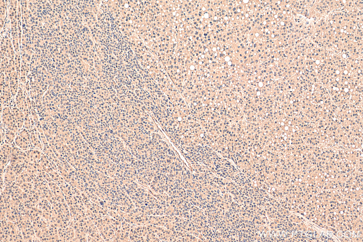 IHC staining of human liver cancer using 67343-1-Ig