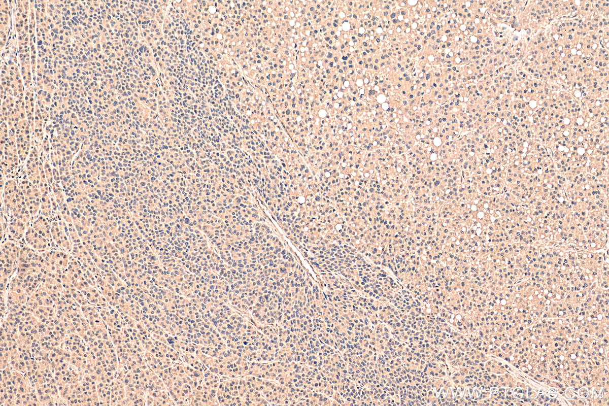 IHC staining of human liver cancer using 67343-1-Ig