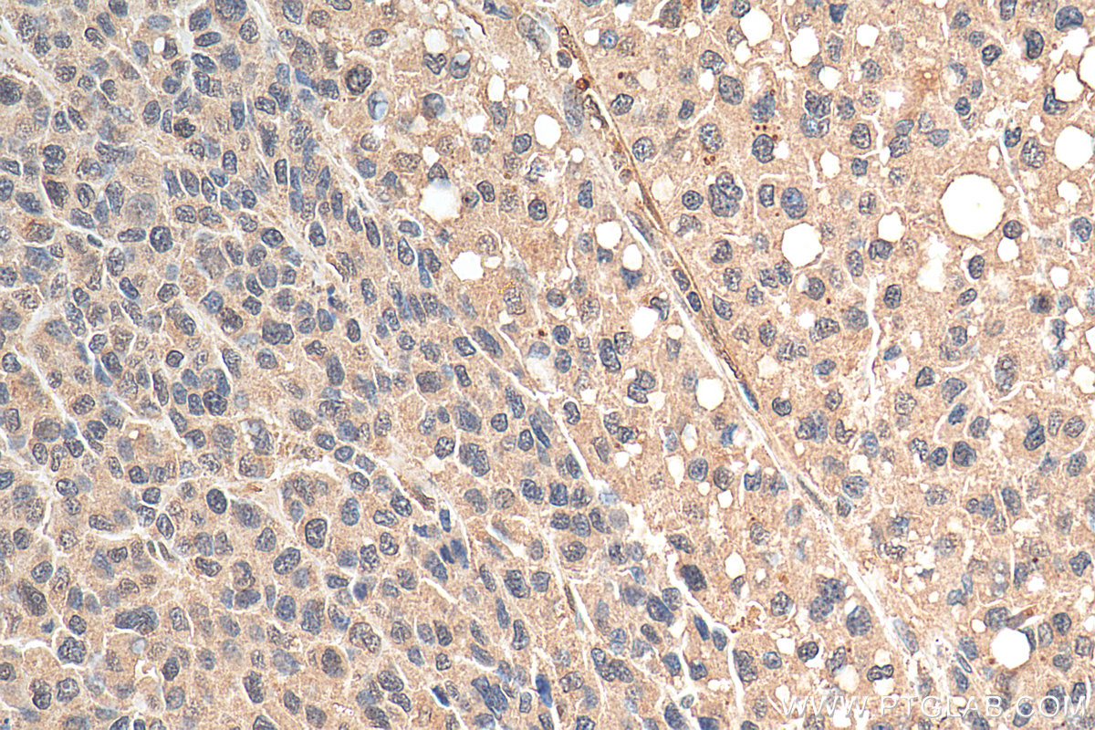 IHC staining of human liver cancer using 67343-1-Ig