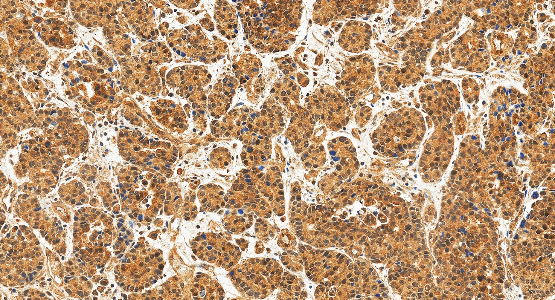 IHC staining of human stomach cancer using 83841-4-RR (same clone as 83841-4-PBS)