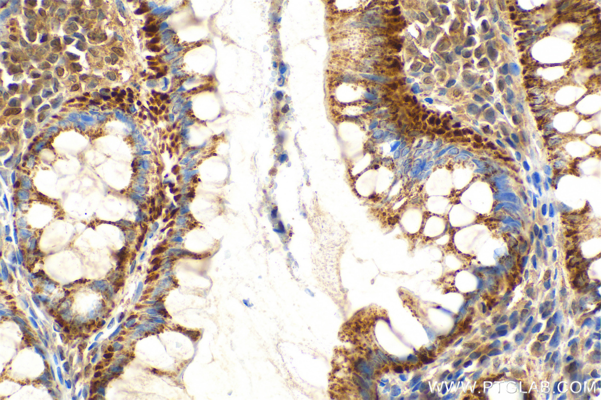 IHC staining of human colon cancer using RMX00035 IHC staining of human colon cancer using RMX00035