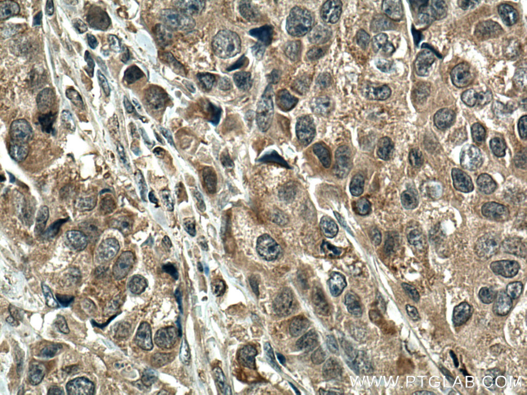 IHC staining of human breast cancer using 67052-1-Ig (same clone as 67052-1-PBS)