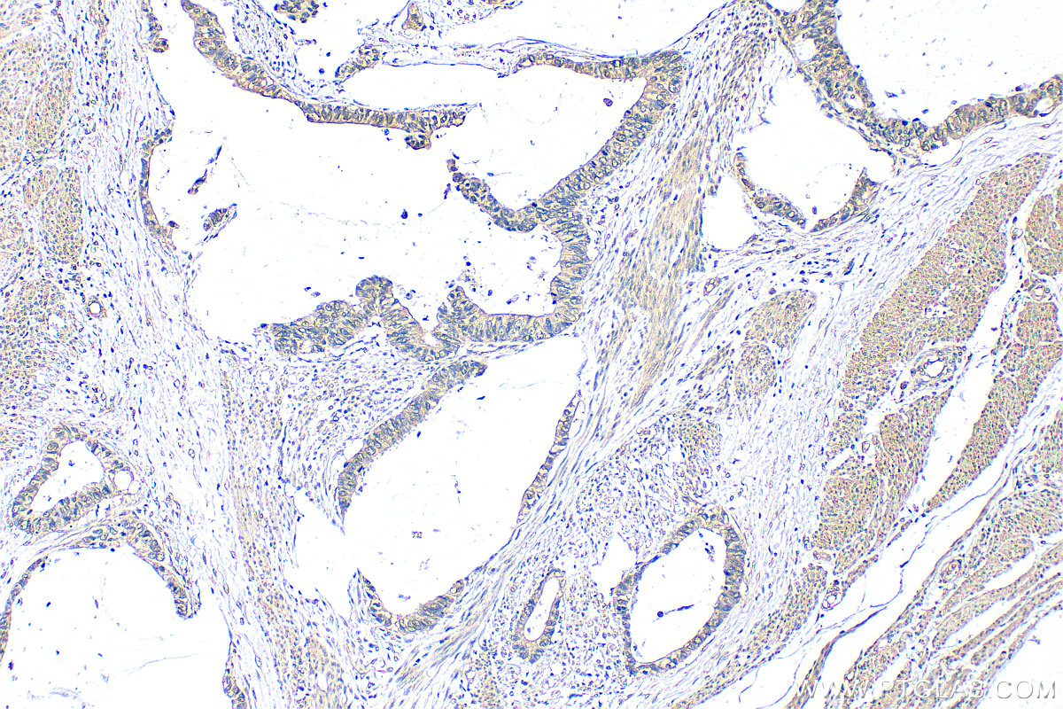 IHC staining of human urothelial carcinoma using 80964-5-RR IHC staining of human urothelial carcinoma using 80964-5-RR