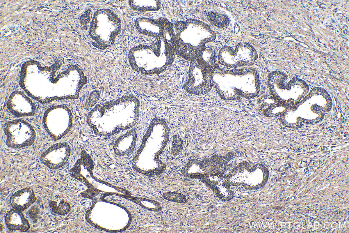 Immunohistochemical analysis of paraffin-embedded human prostate cancer tissue slide using 16397-1-AP (SMAD9 antibody) at dilution of 1:200 (under 10x lens). Heat mediated antigen retrieval with Tris-EDTA buffer (pH 9.0). IHC staining of human prostate cancer using 16397-1-AP