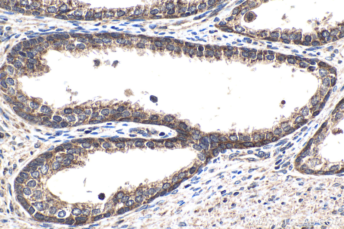 Immunohistochemical analysis of paraffin-embedded human prostate cancer tissue slide using 16397-1-AP (SMAD9 antibody) at dilution of 1:200 (under 40x lens). Heat mediated antigen retrieval with Tris-EDTA buffer (pH 9.0). IHC staining of human prostate cancer using 16397-1-AP