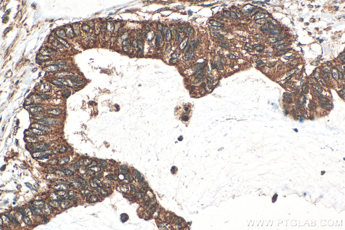 Immunohistochemical analysis of paraffin-embedded human urothelial carcinoma tissue slide using 16397-1-AP (SMAD9 antibody) at dilution of 1:200 (under 40x lens). Heat mediated antigen retrieval with Tris-EDTA buffer (pH 9.0). IHC staining of human urothelial carcinoma using 16397-1-AP