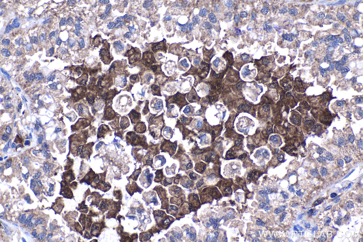 Immunohistochemical analysis of paraffin-embedded human lung cancer tissue slide using 16597-1-AP (SMAP2 antibody) at dilution of 1:200 (under 40x lens). Heat mediated antigen retrieval with Tris-EDTA buffer (pH 9.0). IHC staining of human lung cancer using 16597-1-AP