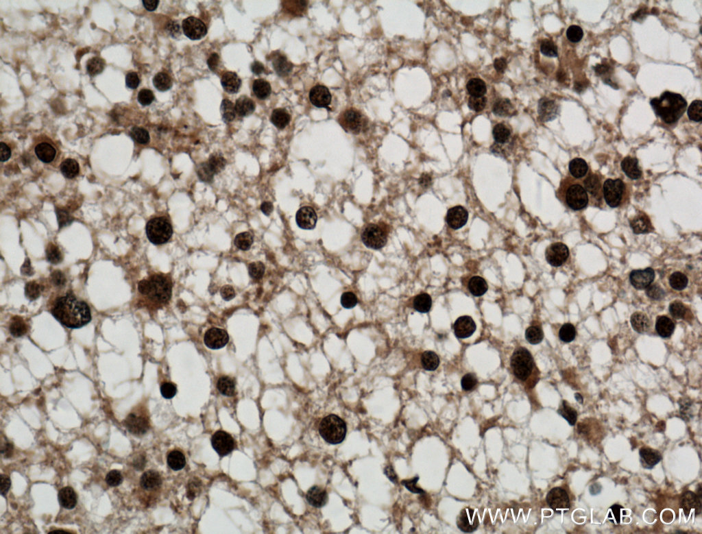 IHC staining of human gliomas using 21695-1-AP