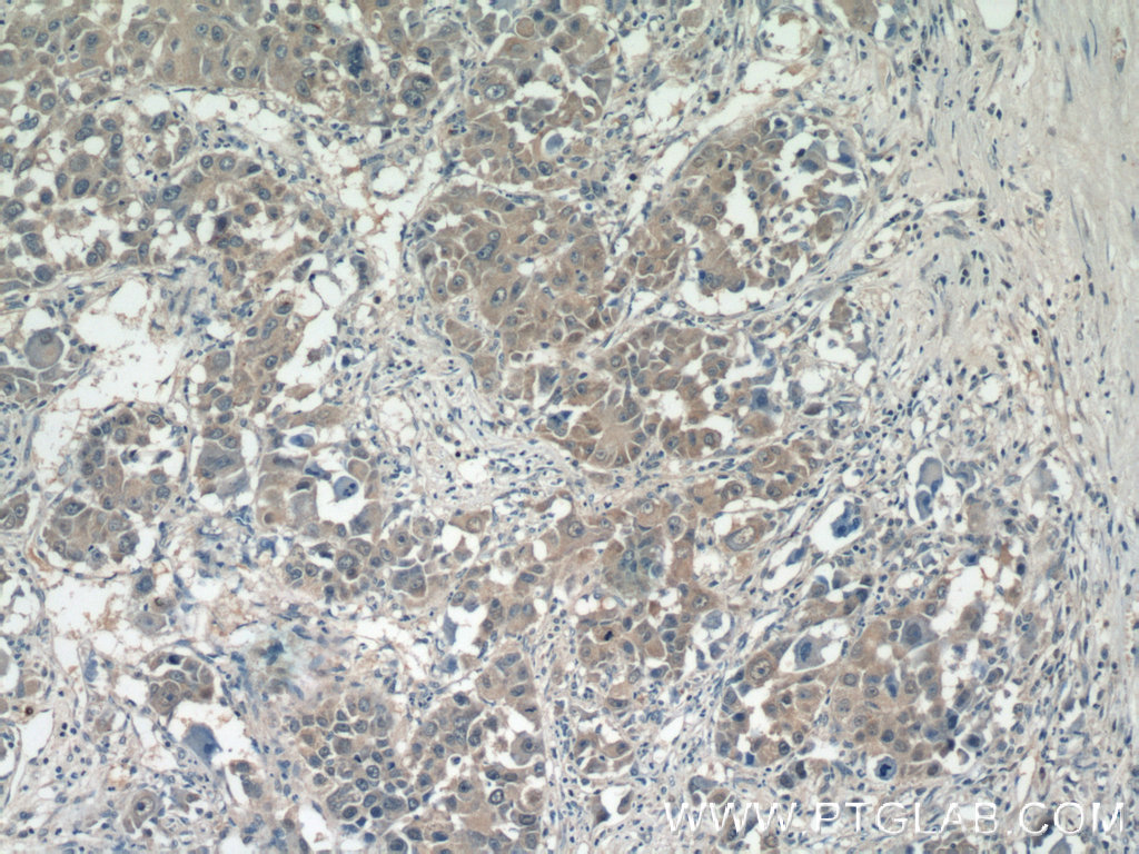 IHC staining of human liver cancer using 16413-1-AP