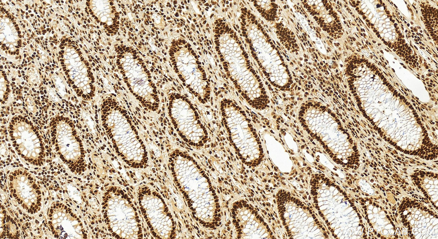 IHC staining of human colon cancer using 26153-1-AP